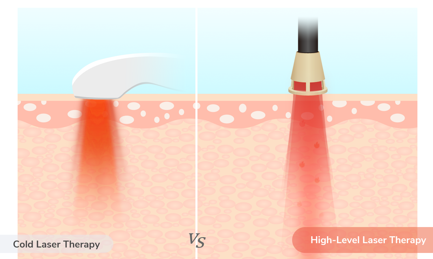 Cold Laser Therapy vs High-Level Laser Therapy: Which Is Better?