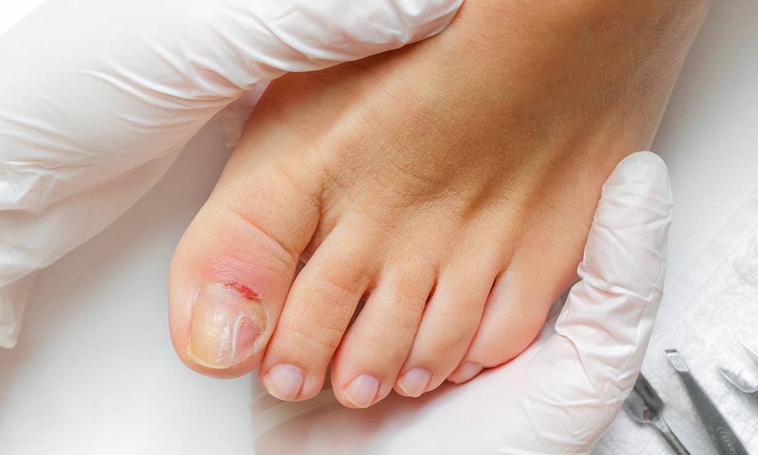Toenail Terror? Laser’s Here to Save Your Sole!