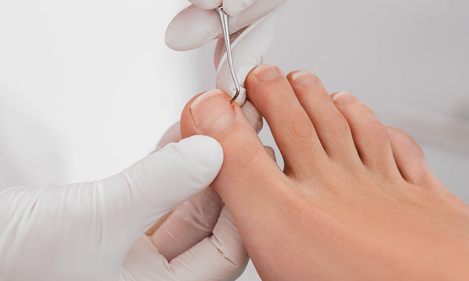Laser Therapy for Toenail Fungus