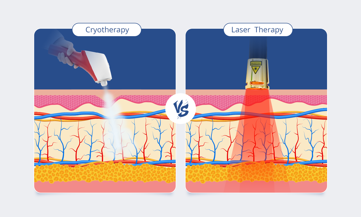 Cryotherapy vs. Laser Therapy for Treating Inflammation